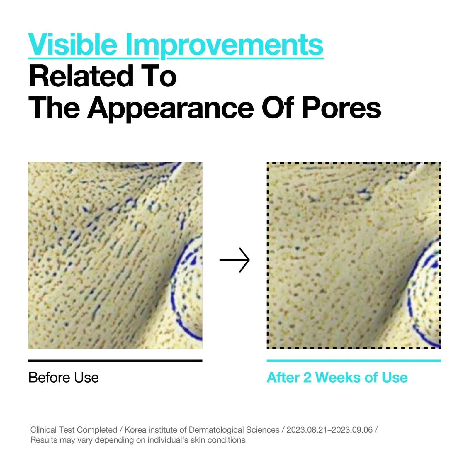 Anua BHA 2% Toner clinical before and after pore close-up after two weeks of use