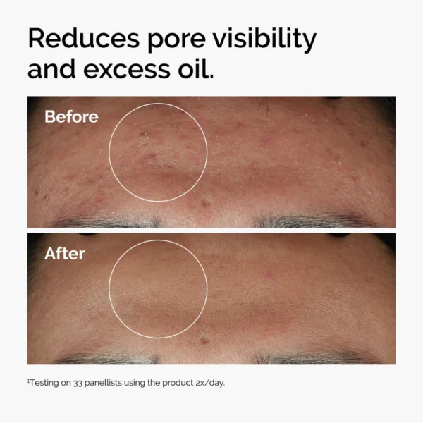 The Ordinary Niacinamide 10% + Zinc before and after pore appearance results