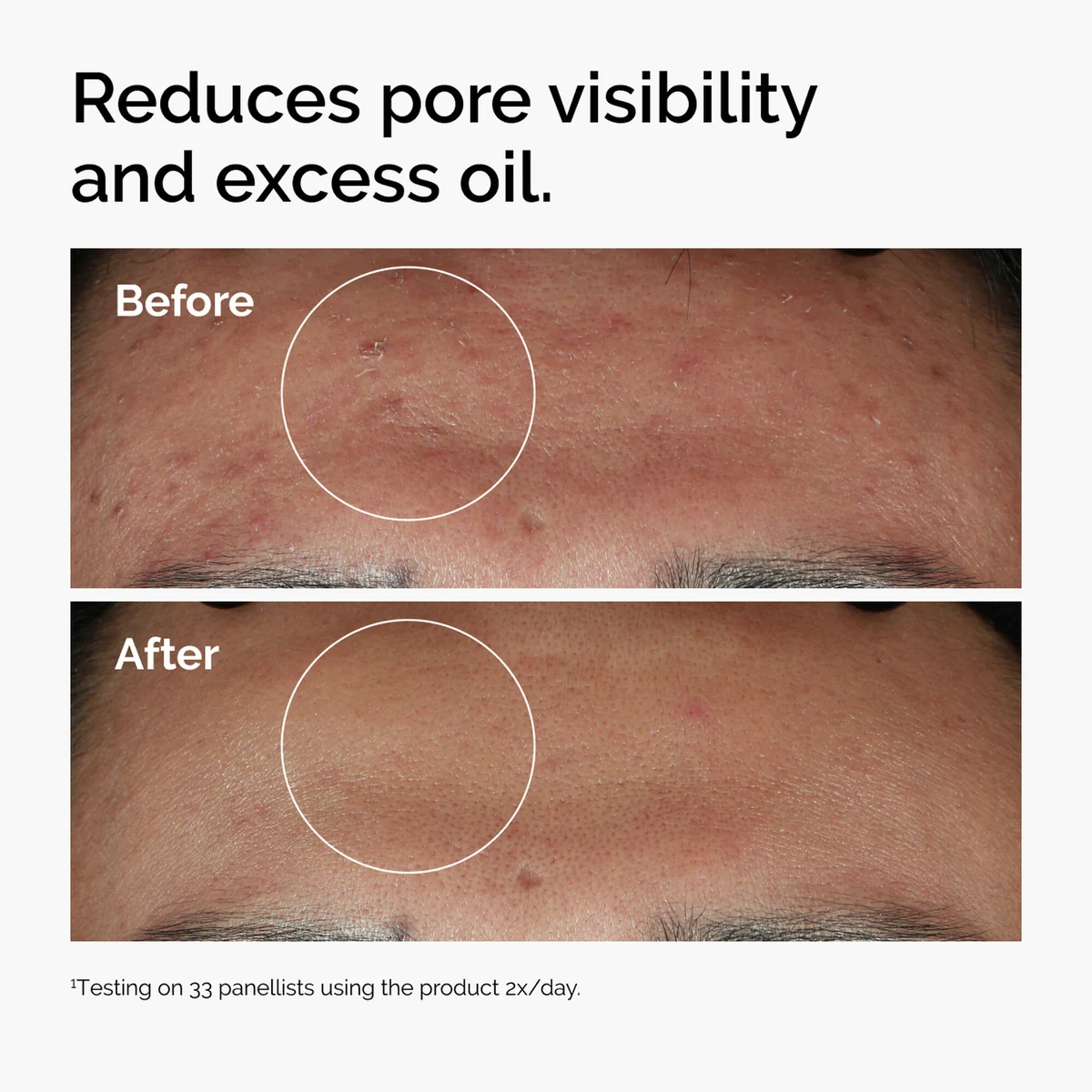 The Ordinary Niacinamide 10% + Zinc before and after pore appearance results